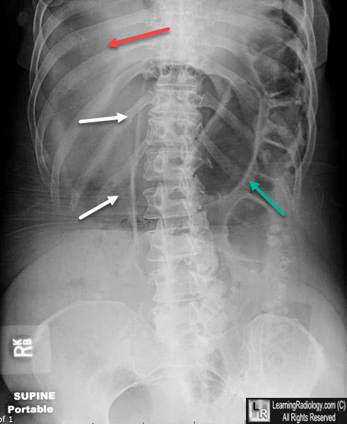 Falciform Ligament Sign (Free Air)